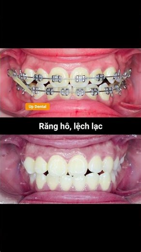 [Cận cảnh 222] Niềng răng thay đổi như thế nào?