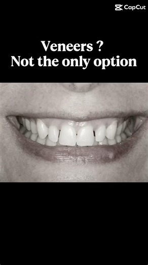 Veneers ?. #MinimallyInvasiveDentistry #DiastemaClosure #SmileTransformation #DentalBonding