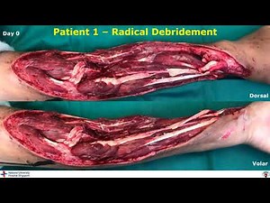 Approach to Mangled Upper Extremity - Dr.Sandeep Sebastin