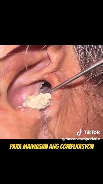 Effective Ear Drops for Fungal Ear Infection Relief