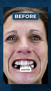 How Dental Implants Affected My Life 🦷