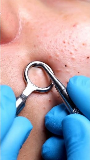 Extreme Close-Up of Blackhead Removal You Must See!