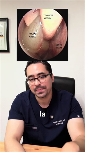 ¿Los lavados nasales curan los pólipos nasales?