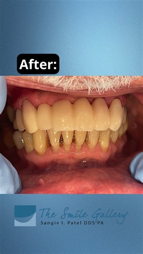 Engineering smiles worth smiling about. ✨ This one-day transformation was powered by CEREC technology, allowing us to digitally design, craft, and place a full top-set restoration — all in a single visit. No waiting. No temporaries. Just a confident smile, same day. 🦷 Same-day smiles start here. Call today or visit our website. Link in bio. 321-254-4613 #ExpertDentist #MelbourneFL #BeautifulSmile #SmileTransformation #EngineeringSmiles | The Smile Gallery