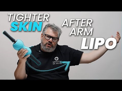 Ogee Roller for Arm Lipo Recovery | Reduce Swelling & Improve Results