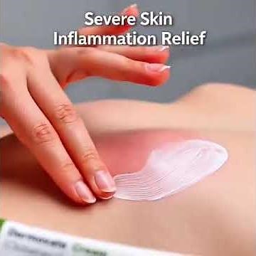 Dermovate Cream (Clobetasol 0.05%) is a very strong topical corticosteroid used for severe inflammat