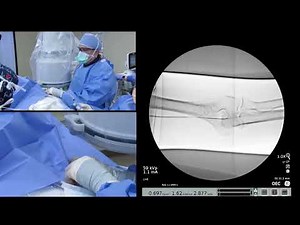 WavelinQ™ EndoAVF System case - Radial/Radial Creation