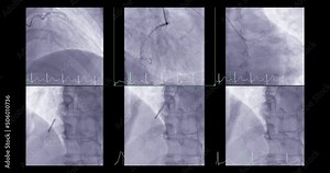 Cardiac catheterization showing coronary arteries for diagnosis cardiac arrest .