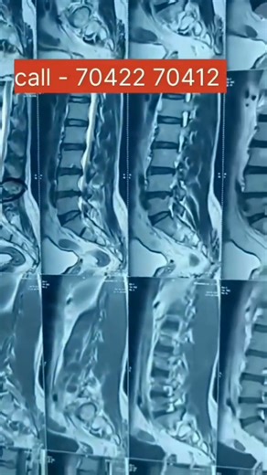 Heal Max Clinic And Research Center on Instagram: "L4L5 L5S1 DISC BULGE WITH NERVE COMPRESSION COMPLETE CURE BY HEALTH MAX CLINIC AND RESEARCH CENTER SEC 8 DWARKA. Disc Bulge Explained: Causes, Symptoms & Best Treatments Are you struggling with back pain, sciatica, or discomfort caused by a disc bulge? You're not alone! A bulging disc can affect your daily life, making even simple activities painful. In this comprehensive video, I explain everything you need to know about disc bulges, including: