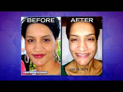 Hear Woman’s Story of Ultherapy Gone Wrong!