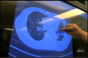 Dr. David Sugarbaker comments on episode 2 of BostonMed