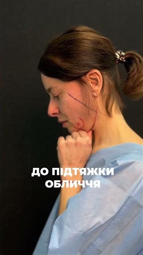 Кругова підтяжка обличчя