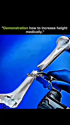 Who Am i ? on Instagram: "Demonstration: How Height Can Be Increased Medically Height increase isn’t just a myth or cosmetic trick—it’s a medically studied process rooted in biology and biomechanics. This demonstration highlights how controlled medical techniques can influence bone length over time. The human body, especially during growth or recovery, responds to tension and stress by generating new bone tissue—a principle known as distraction osteogenesis. In medical settings, this process inv