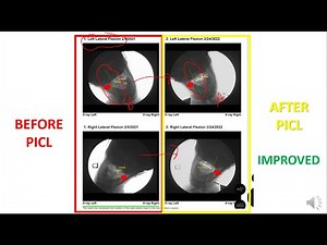 PICL DMX (Digital Motion X-Ray) Before and After Case Series