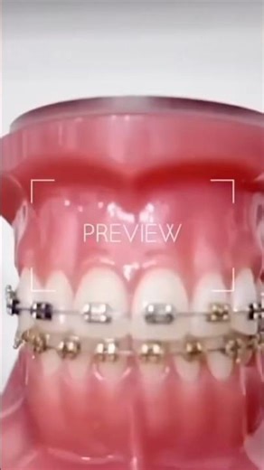 I got braces..AGAIN! Full VLOG on my YT channel #bracesjourney #braces #braceface #subscribe