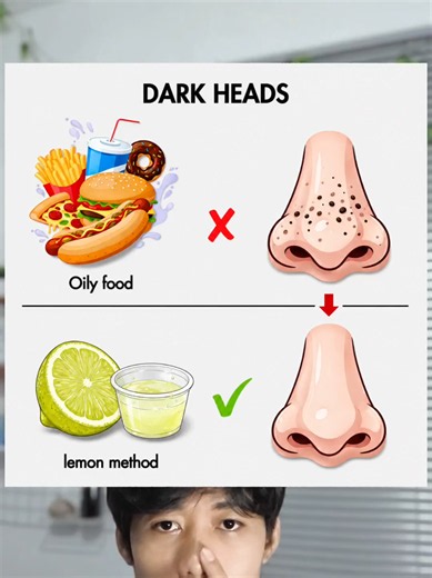 Lemon method for blackheads🤔 #lemonmethod #lemon #blackhead #blackheadsremoval #komedo