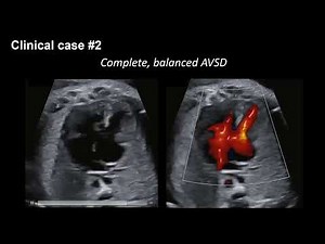 2025 Fetal Echocardiography: Normal and Abnormal Hearts