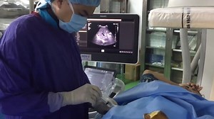 Đốt sóng cao tần u gan dưới hướng dẫn của siêu âm được thực hiện như thế nào? - Bệnh viện Việt Đức