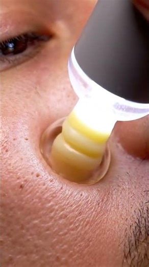 Extreme macro shot of inflamed pimples and blackheads on unclean skin