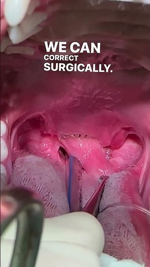 Elongated Soft Palate & Laser Surgery (Staphylectomy)