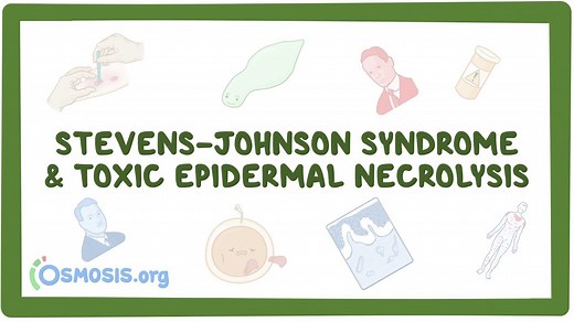 Stevens-Johnson syndrome: Video, Causes, & Meaning | Osmosis