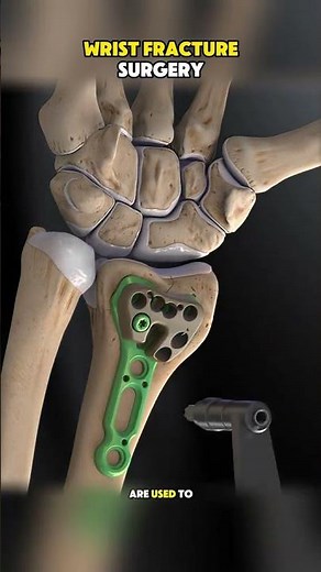 Wrist Fracture Surgery Explained | Distal Radius Fracture ORIF | Step-by-Step Orthopedic Procedure 😲