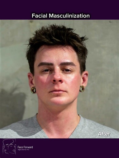 Facial Masculinization| Before and After| Facial Plastic Surgery