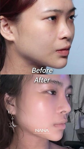 These results are lowkey insane #koreaplasticsurgery