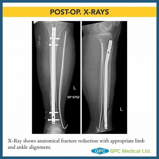 Management Technique (Nailing) for Distal Tibia Communited Extraarticular with Fibula Stabilisation