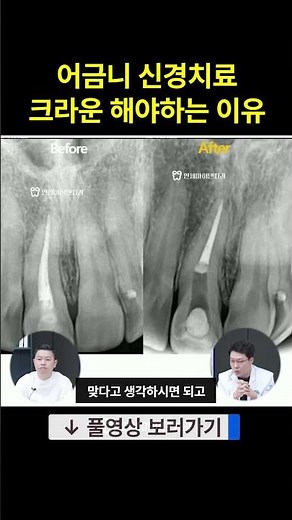 Why is a crown absolutely necessary after a molar root canal?