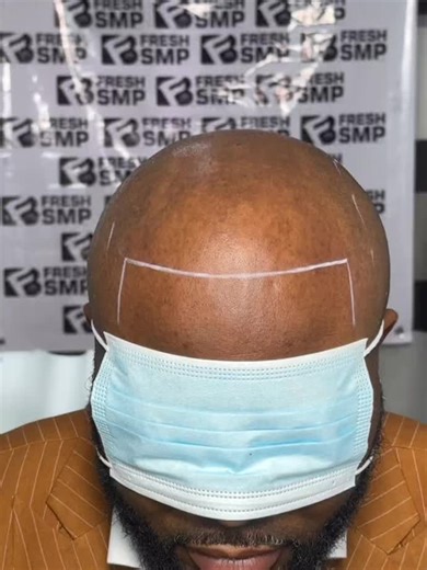 🧢 “Hairlines fade. Confidence shouldn’t.” 🔥 Restore yours with SMP—natural look, lasting results. Dm for a free consultation @fresh_smp_studio @fresh_barbers Contact us via WhatsApp: 2347068213149