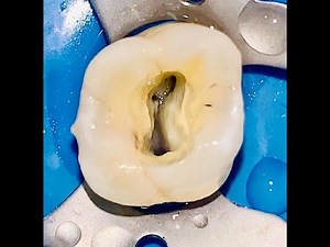 Maxillary Molar Access Opening