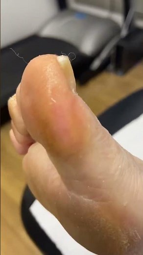 Satisfying Big Toe Callus Removal by Podiatrist #CallusRemoval #FootCare