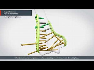 [ARIX OS] ARIX Elbow - Distal Humerus Surgical Guide