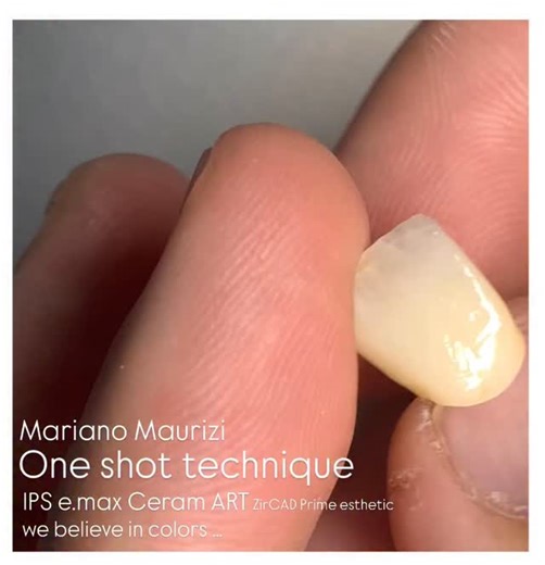 M A R I A N O M A U R I Z I | Monolithic solutions With lPS e.max Ceram ART ONE shot technique… #emax #dentist #dentistry #milling #zirconia #odontolove... | Instagram