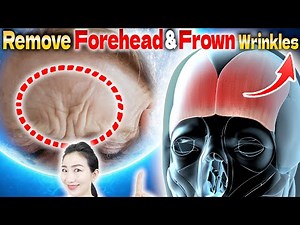 Peeling Frontal Fascia Removes Forehead Wrinkles and Frown Lines