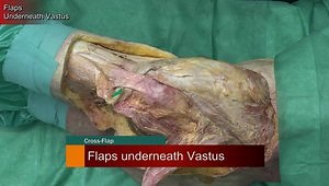 Cross Flap Technique for the Treatment of Gluteal Insufficiency