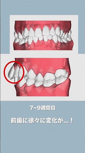 平均3ヶ月で理想的な歯並びに #マウスピース矯正 #矯正 #ohmyteeth