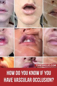 How do you know if you have vascular occlusion? - TimesMojo