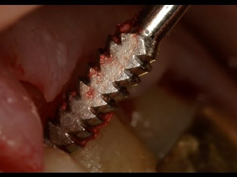 What is the Sugarman file? (a SurgicalMaster review)