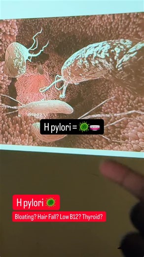 Not just “acidity.” Not just “gas.” It’s a bacteria that can quietly live inside your stomach. Here’s what actually happens inside 👇 🔽 Downward mechanism (damage phase) 🦠 It produces urease → converts urea into ammonia → creates a protective bubble against stomach acid 🛡️ It weakens your stomach’s mucus lining 🔥 Your immune system reacts → chronic inflammation begins ⚡ Acid balance gets disturbed Some people get high acid → burning, ulcers Some get low acid → bloating, poor digestion 🩸 Lon