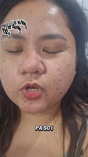 Derma Roller before and After REAL RESULTS 💆‍♀️ 4 Months of using dermaroller from Derma Roller PH