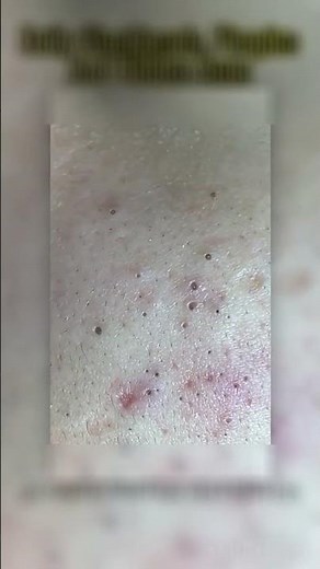 Relax and watch this satisfying acne and blackhead extraction video #PimplePopping #acne #blackhead