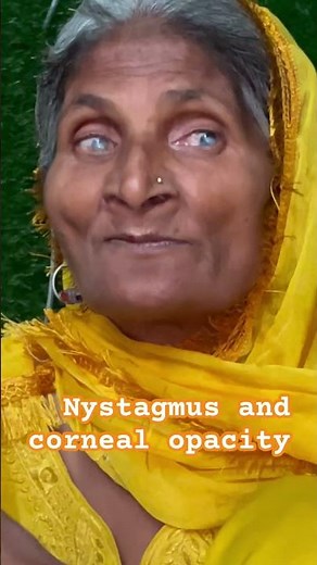Corneal Opacity|| Nystagmus || Optometry Solution