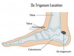 Síndrome del hueso trígono u os trigonum