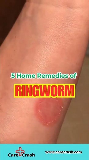 5 Effective Home Remedies for Ringworm | #carecrash