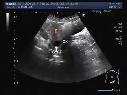 Ultrasound Video showing a cervical cyst.