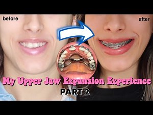 My Upper Jaw Expansion Experience PART 2 (SARPE Surgery + Palatal Expander)
