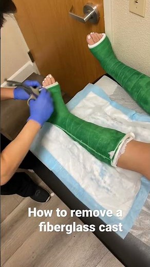 How to remove a fiberglass cast. #casting #fracture #castremoval #orthopedics #podiatry