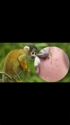 Removing Acne Blackheads on skin, cleaning everywhere